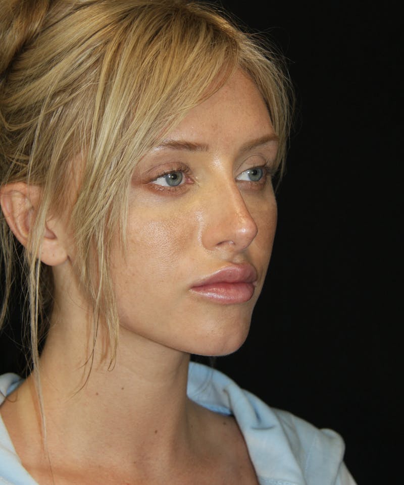 Non-Surgical Rhinoplasty Before & After Gallery - Patient 181881634 - Image 4