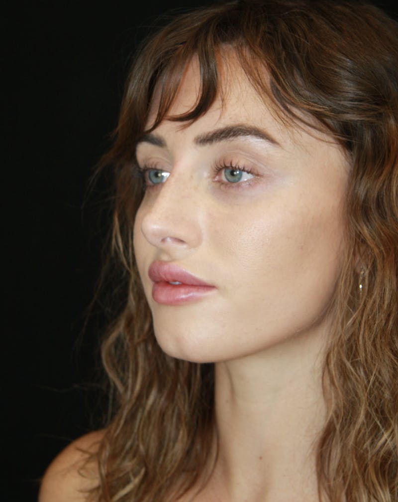 Non-Surgical Rhinoplasty Before & After Gallery - Patient 181881634 - Image 5