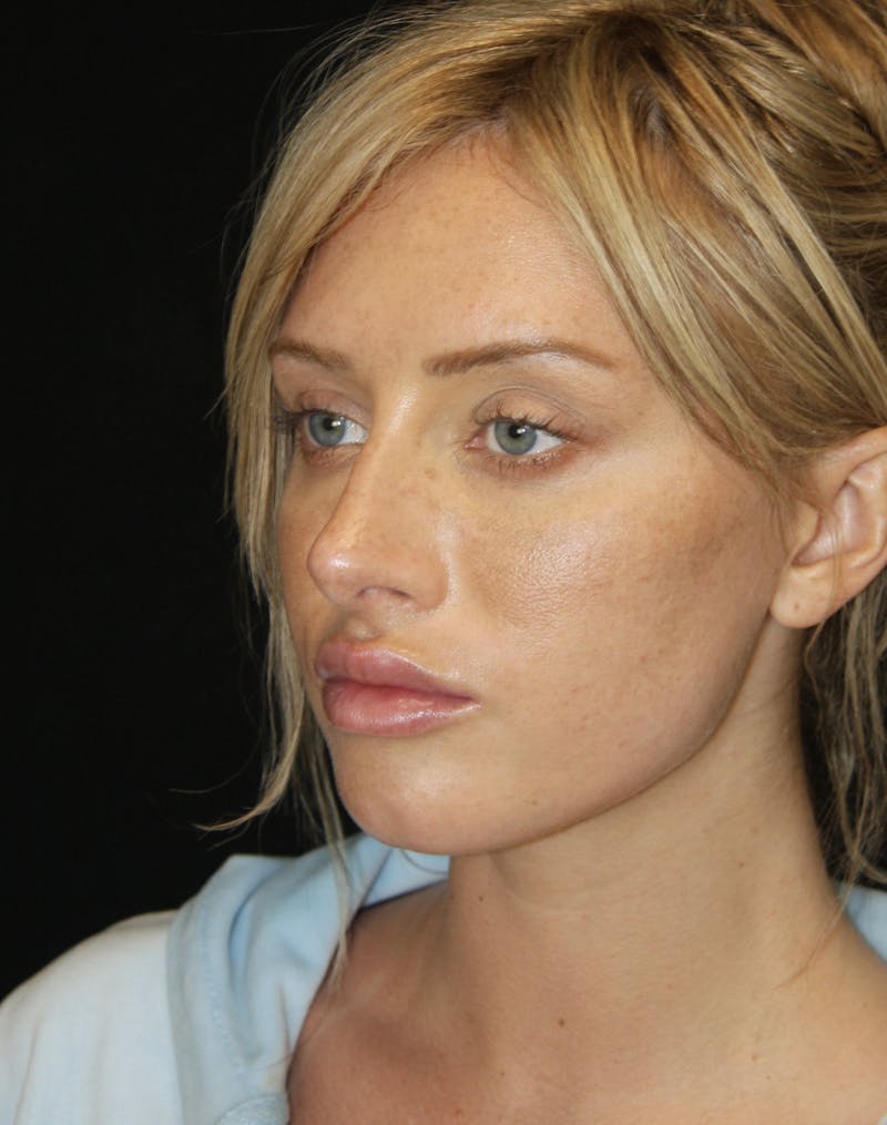 Non-Surgical Rhinoplasty Before & After Gallery - Patient 181881634 - Image 6