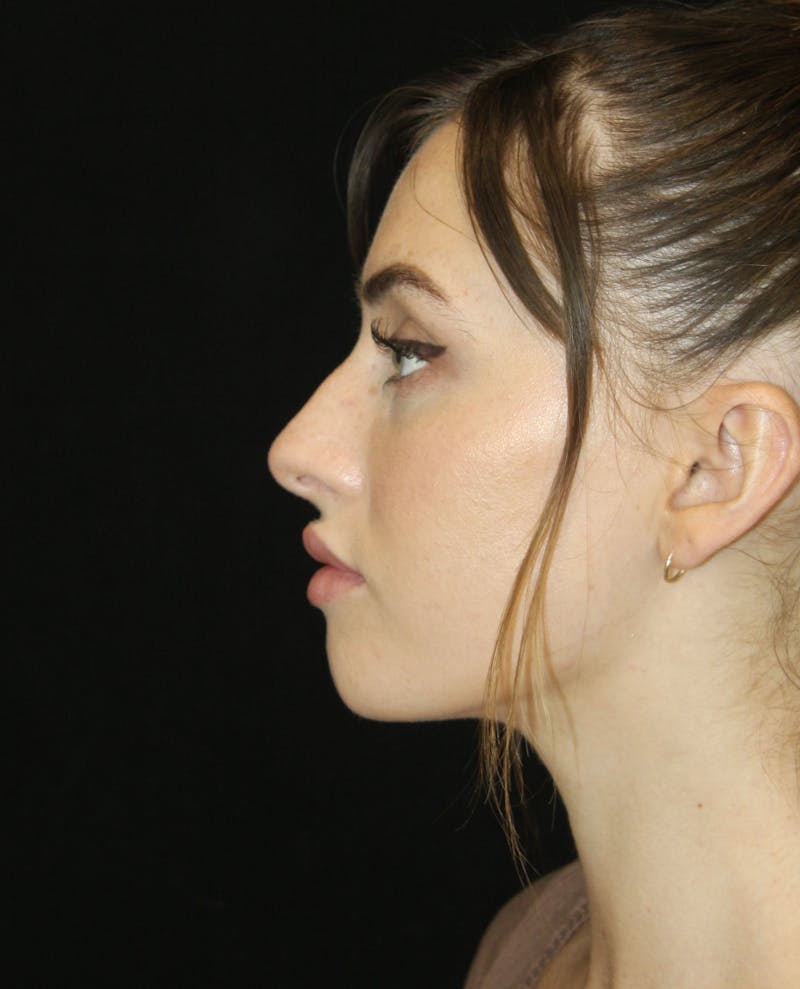 Non-Surgical Rhinoplasty Before & After Gallery - Patient 181881634 - Image 7