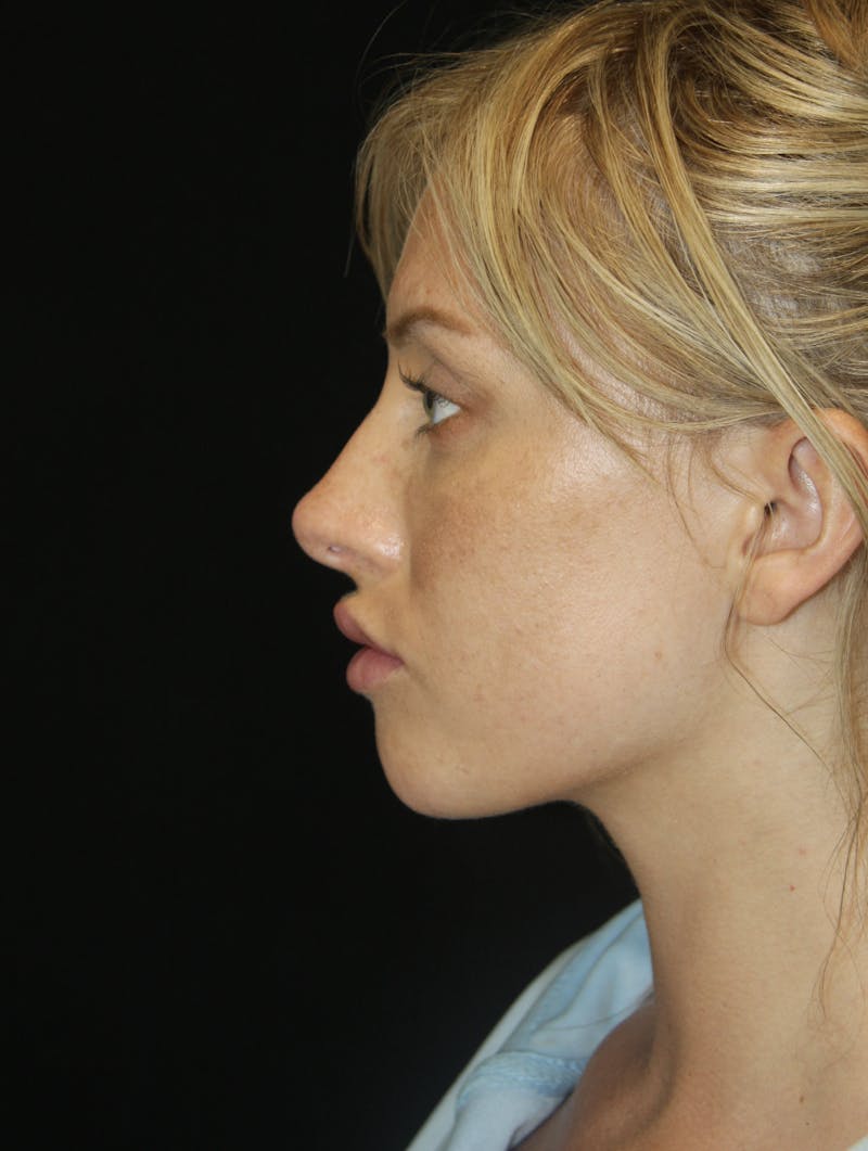 Non-Surgical Rhinoplasty Before & After Gallery - Patient 181881634 - Image 8