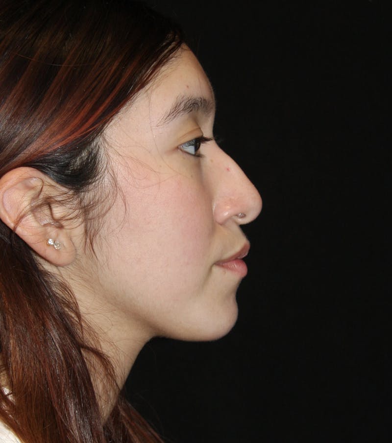 Non-Surgical Rhinoplasty Before & After Gallery - Patient 181881696 - Image 1