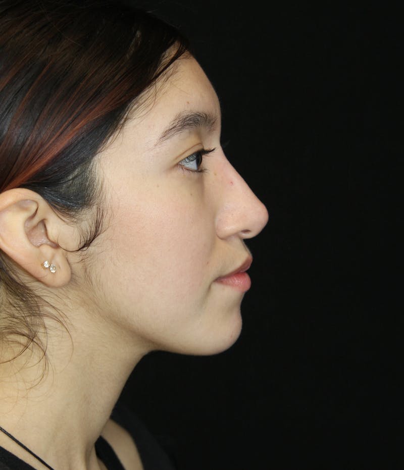 Non-Surgical Rhinoplasty Before & After Gallery - Patient 181881696 - Image 2