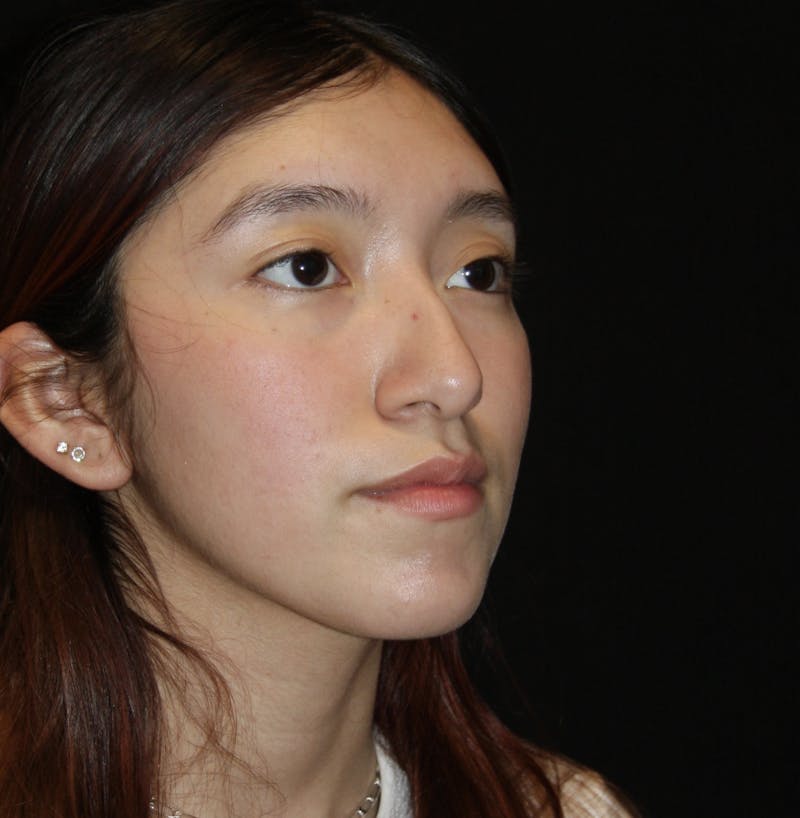 Non-Surgical Rhinoplasty Before & After Gallery - Patient 181881696 - Image 3