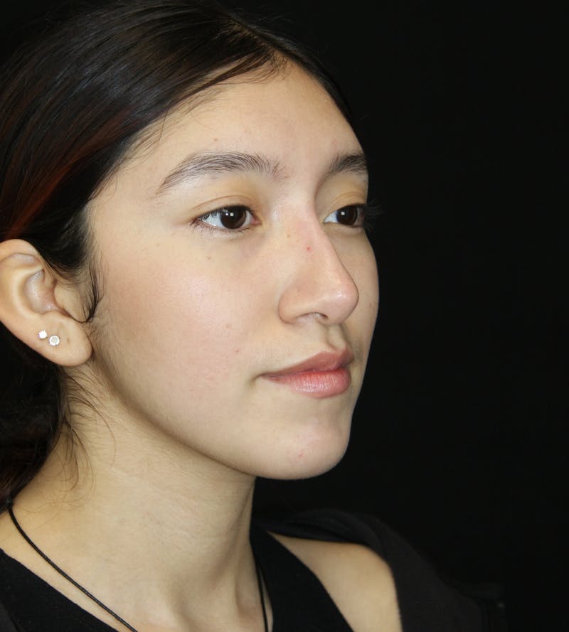 Non-Surgical Rhinoplasty Before & After Gallery - Patient 181881696 - Image 4