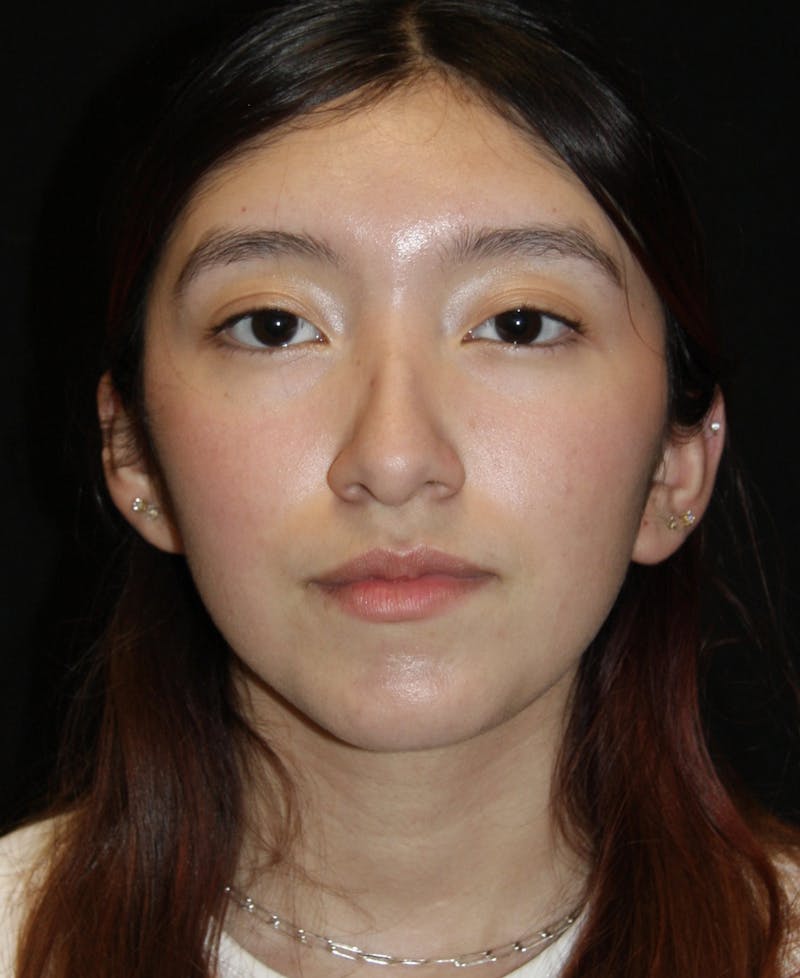 Non-Surgical Rhinoplasty Before & After Gallery - Patient 181881696 - Image 5