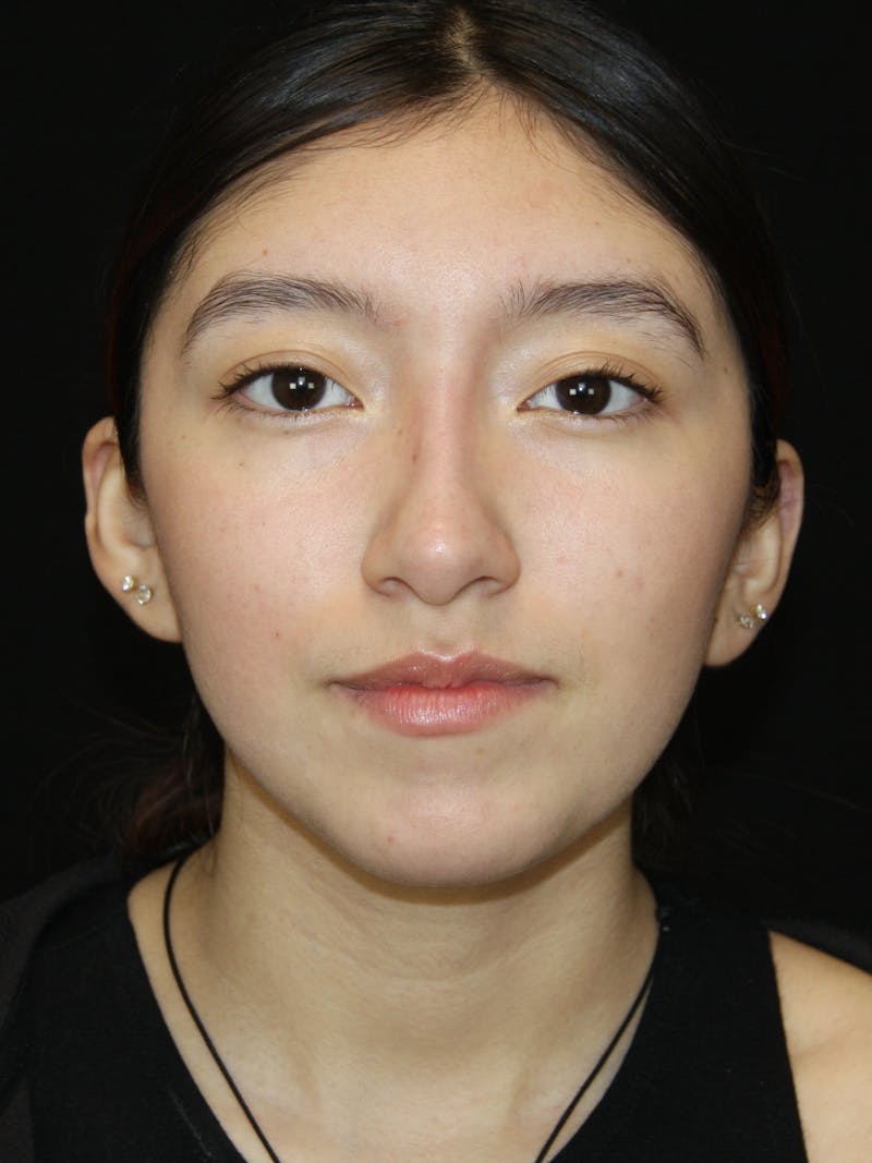 Non-Surgical Rhinoplasty Before & After Gallery - Patient 181881696 - Image 6
