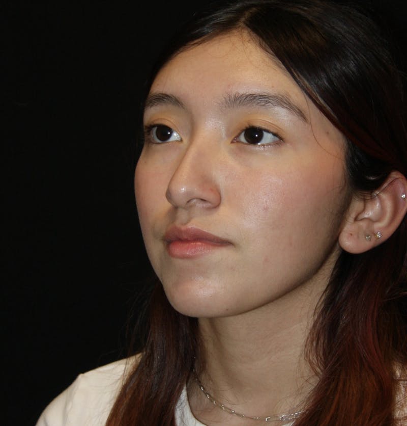 Non-Surgical Rhinoplasty Before & After Gallery - Patient 181881696 - Image 7