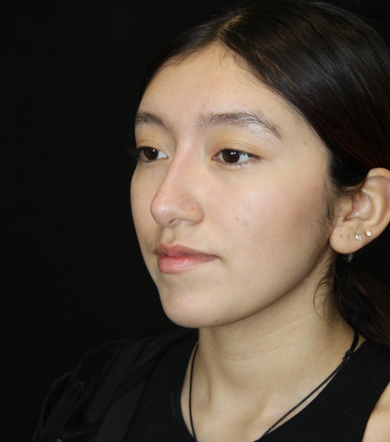 Non-Surgical Rhinoplasty Before & After Gallery - Patient 181881696 - Image 8