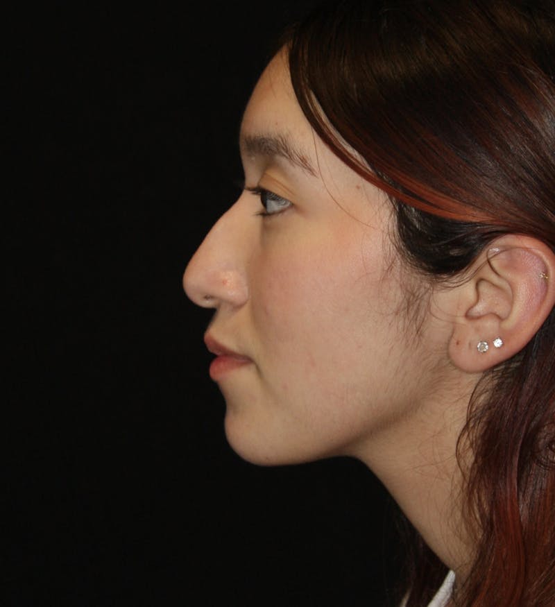 Non-Surgical Rhinoplasty Before & After Gallery - Patient 181881696 - Image 9