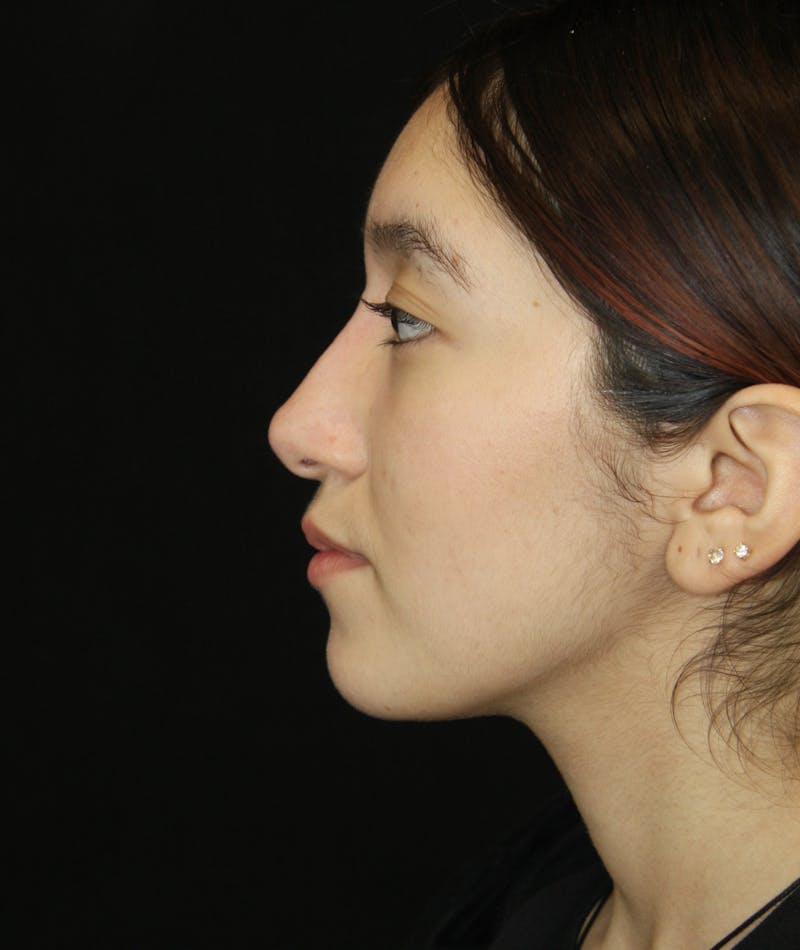 Non-Surgical Rhinoplasty Before & After Gallery - Patient 181881696 - Image 10