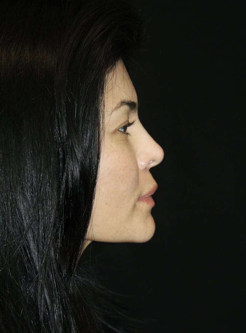 Non-Surgical Rhinoplasty Before & After Gallery - Patient 181881719 - Image 2
