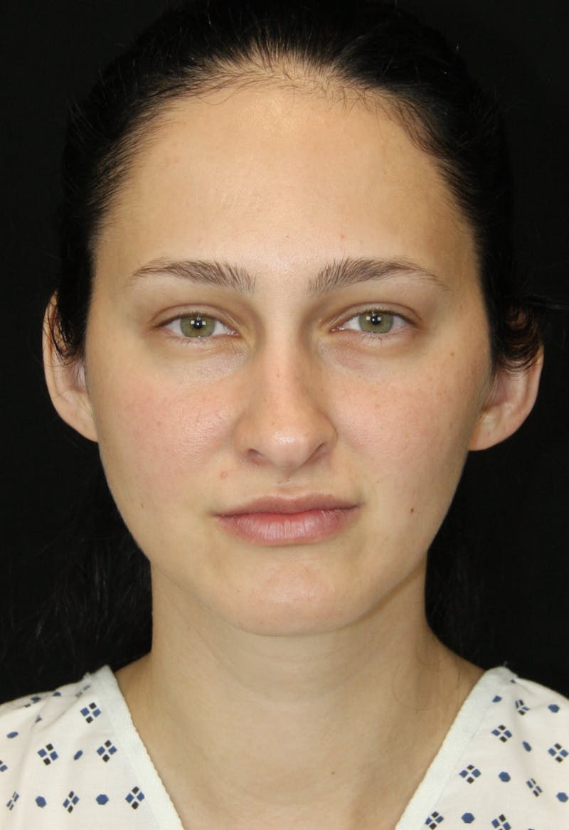 Rhinoplasty Before & After Gallery - Patient 181881815 - Image 1