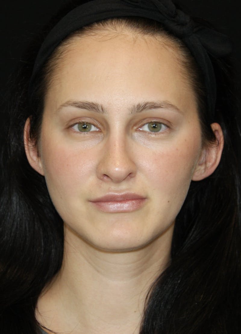 Rhinoplasty Before & After Gallery - Patient 181881815 - Image 2
