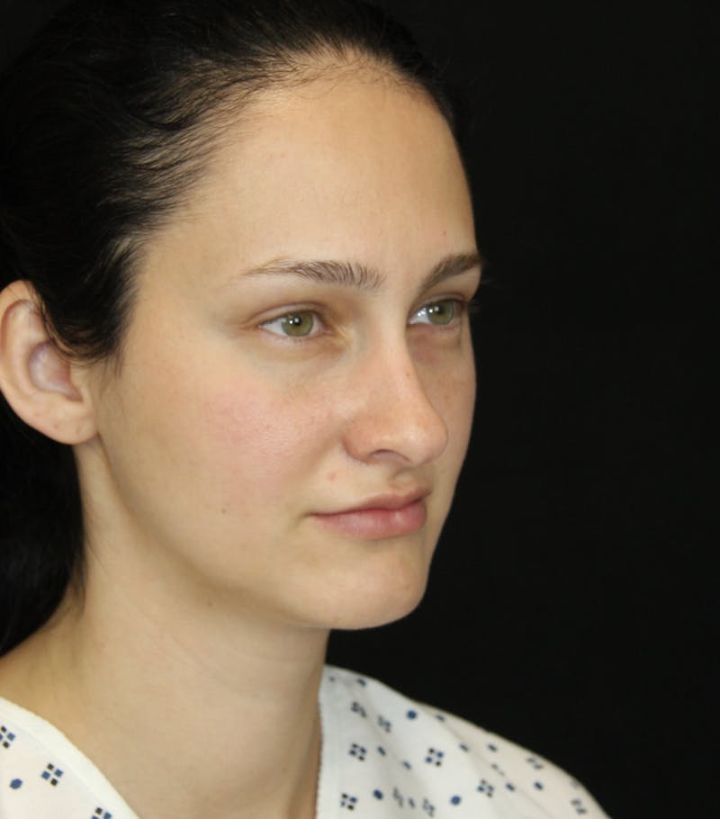 Rhinoplasty Before & After Gallery - Patient 181881815 - Image 3