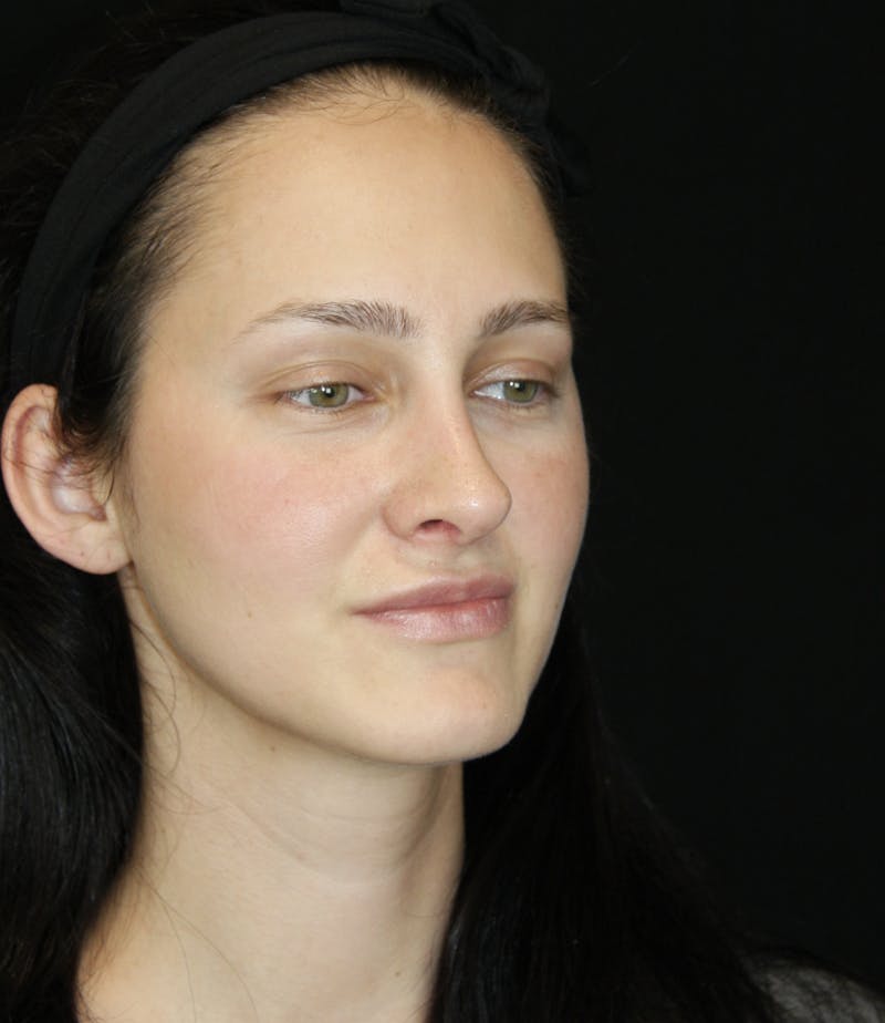 Rhinoplasty Before & After Gallery - Patient 181881815 - Image 4