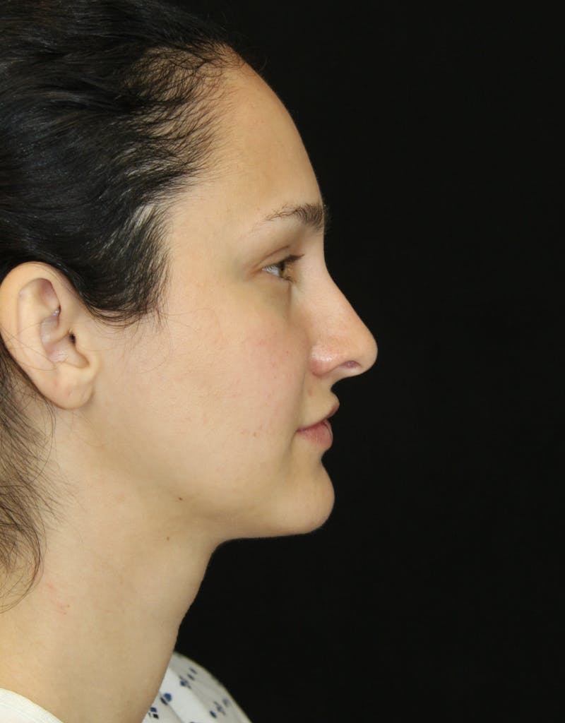 Rhinoplasty Before & After Gallery - Patient 181881815 - Image 5