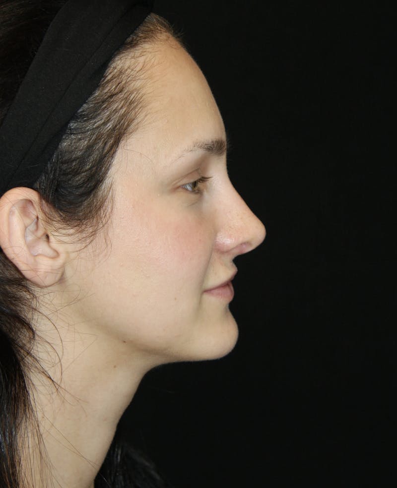 Rhinoplasty Before & After Gallery - Patient 181881815 - Image 6