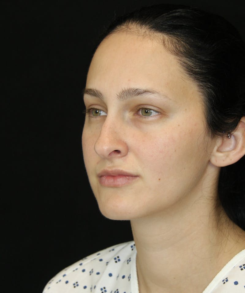 Rhinoplasty Before & After Gallery - Patient 181881815 - Image 7