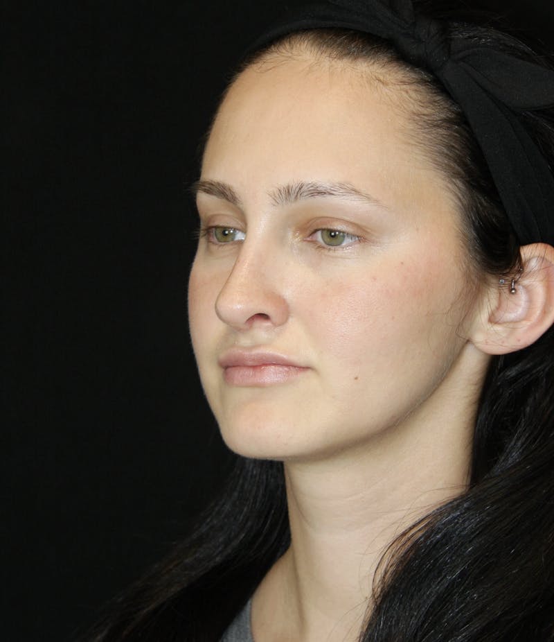 Rhinoplasty Before & After Gallery - Patient 181881815 - Image 8