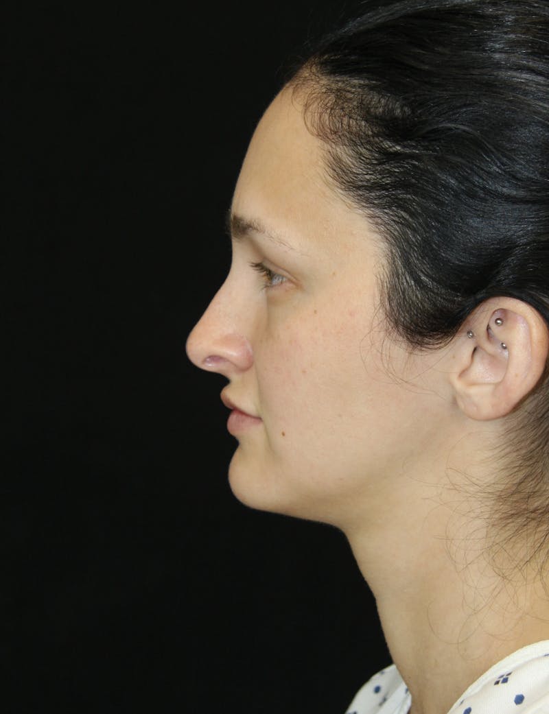 Rhinoplasty Before & After Gallery - Patient 181881815 - Image 9