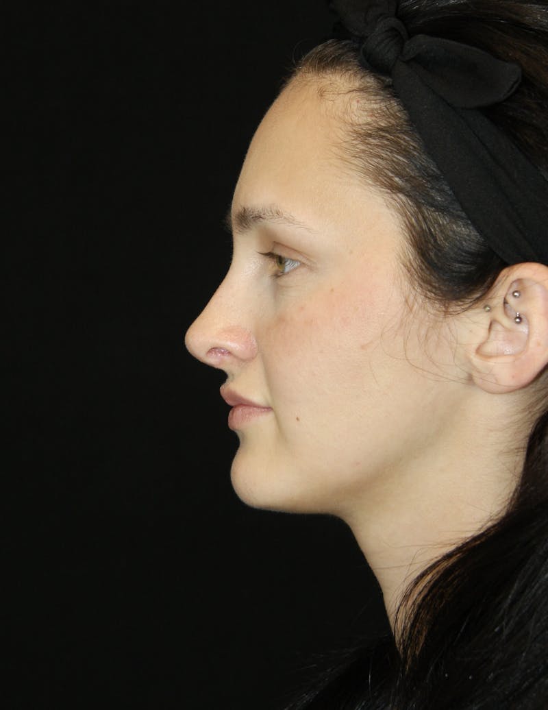 Rhinoplasty Before & After Gallery - Patient 181881815 - Image 10