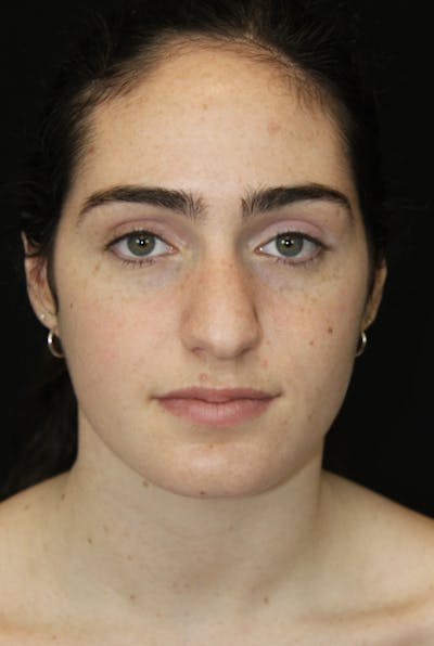 Rhinoplasty Before & After Gallery - Patient 181881864 - Image 1