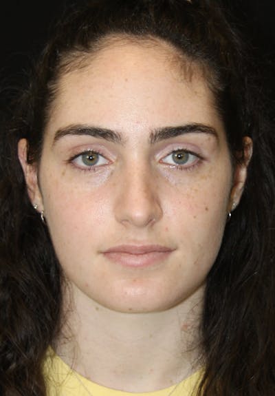Rhinoplasty Before & After Gallery - Patient 181881864 - Image 2