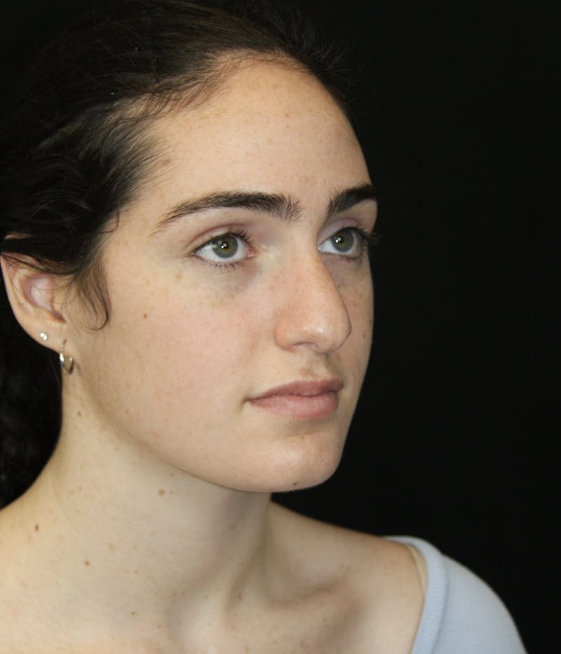 Rhinoplasty Before & After Gallery - Patient 181881864 - Image 3