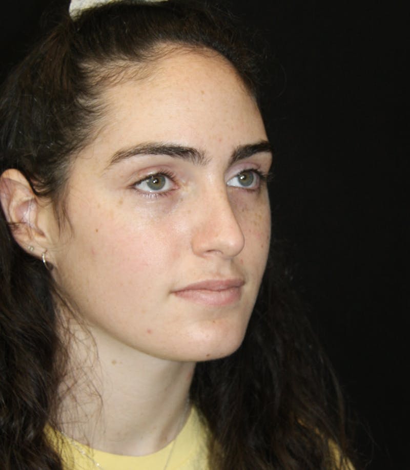 Rhinoplasty Before & After Gallery - Patient 181881864 - Image 4