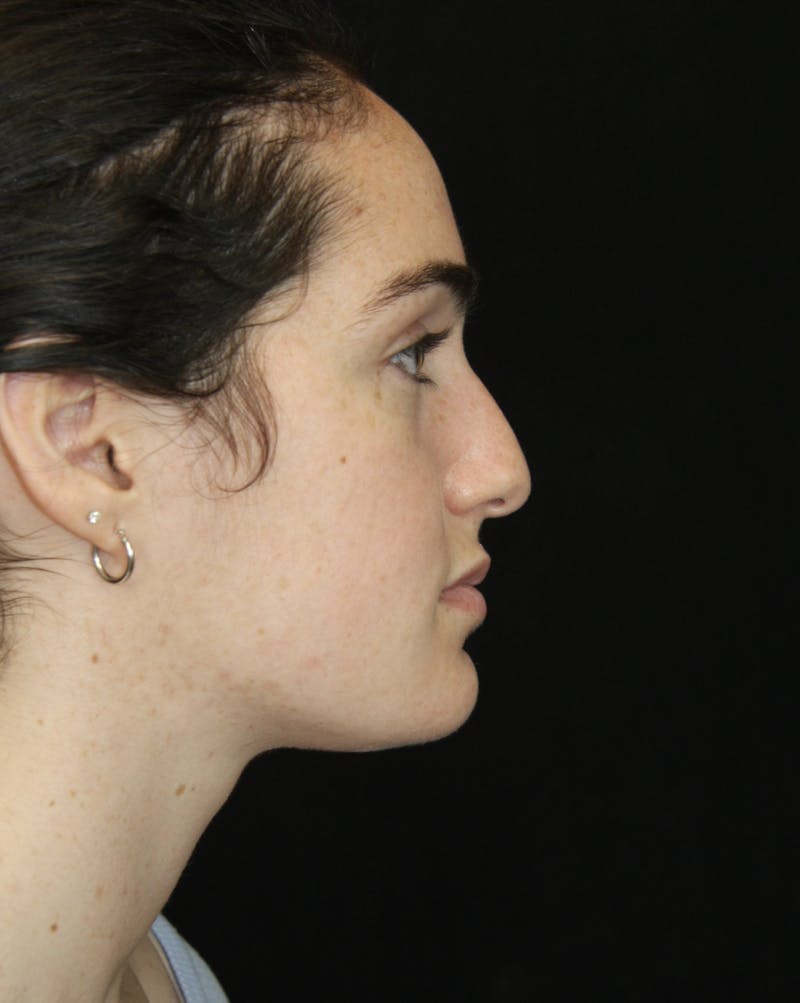 Rhinoplasty Before & After Gallery - Patient 181881864 - Image 5