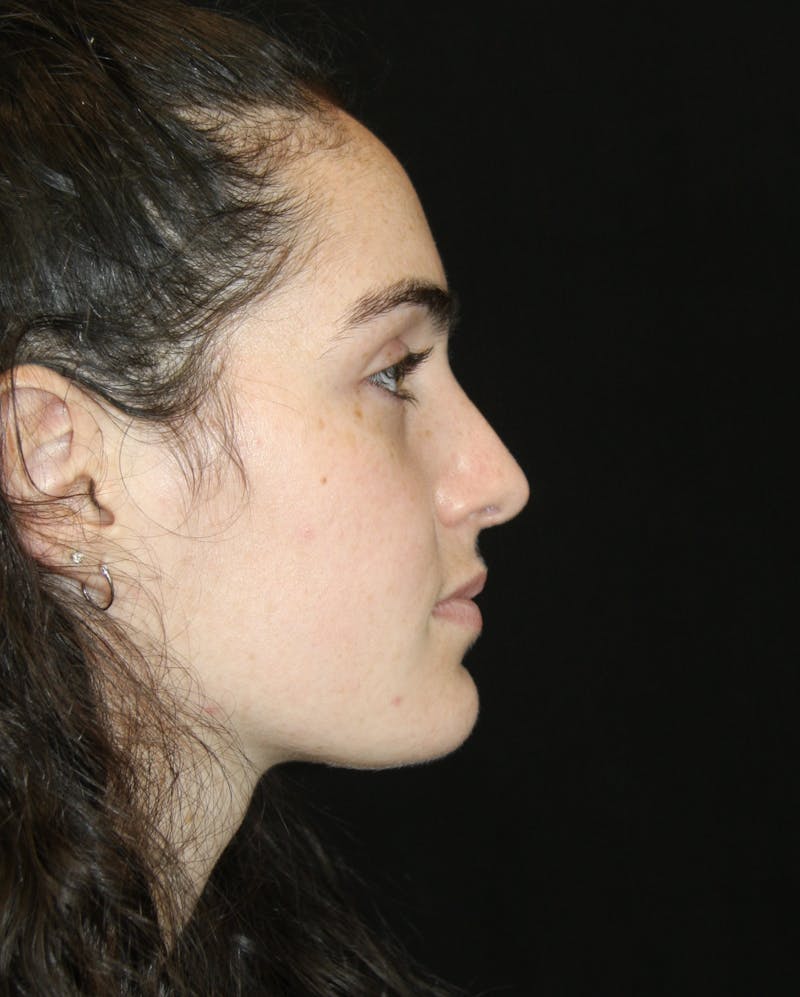 Rhinoplasty Before & After Gallery - Patient 181881864 - Image 6