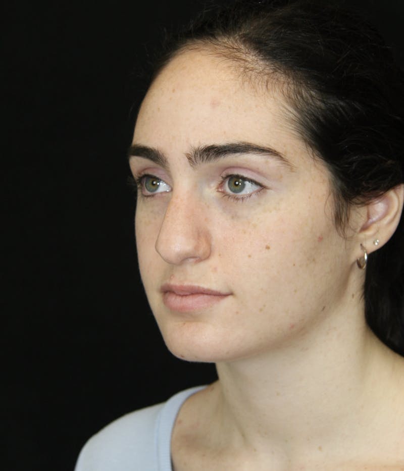 Rhinoplasty Before & After Gallery - Patient 181881864 - Image 7