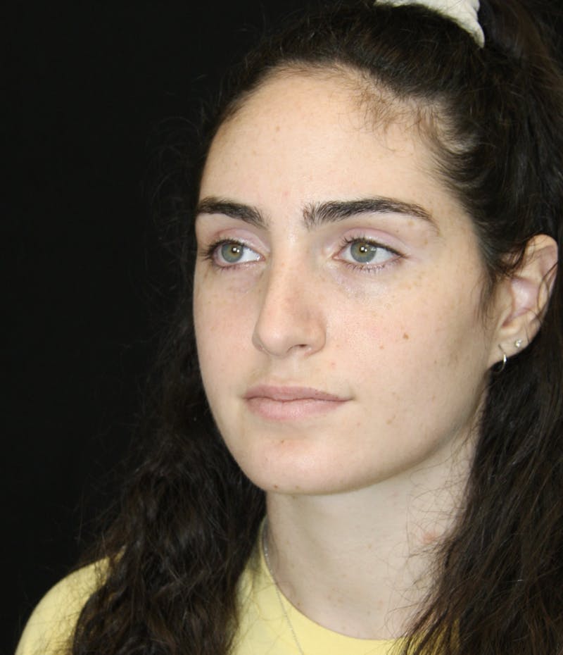 Rhinoplasty Before & After Gallery - Patient 181881864 - Image 8
