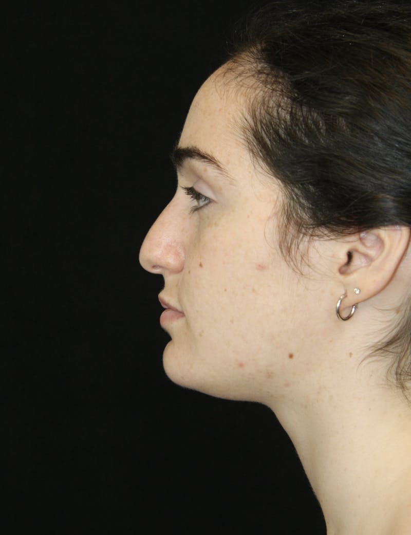 Rhinoplasty Before & After Gallery - Patient 181881864 - Image 9
