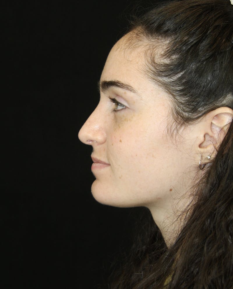 Rhinoplasty Before & After Gallery - Patient 181881864 - Image 10