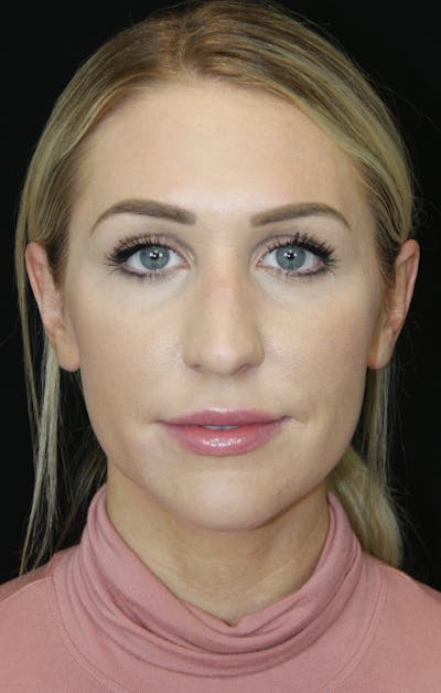 Rhinoplasty Before & After Gallery - Patient 181883655 - Image 1