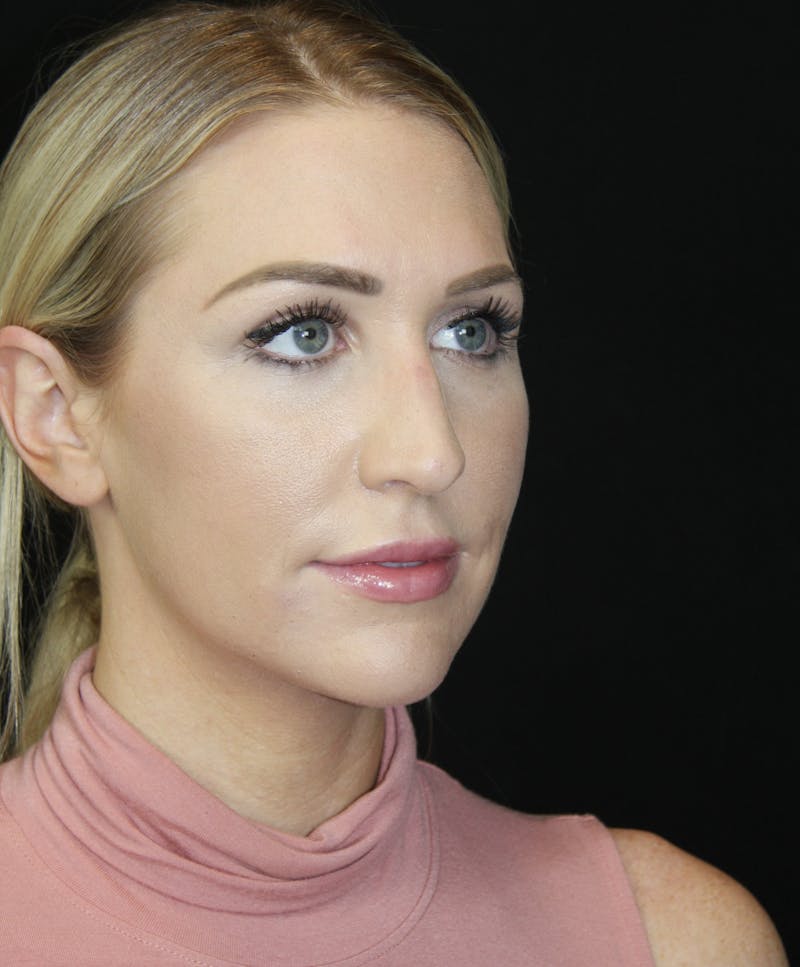 Rhinoplasty Before & After Gallery - Patient 181883655 - Image 3