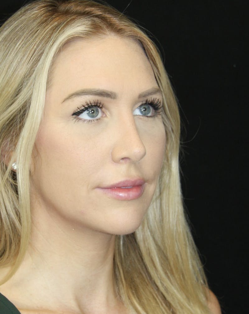Rhinoplasty Before & After Gallery - Patient 181883655 - Image 4