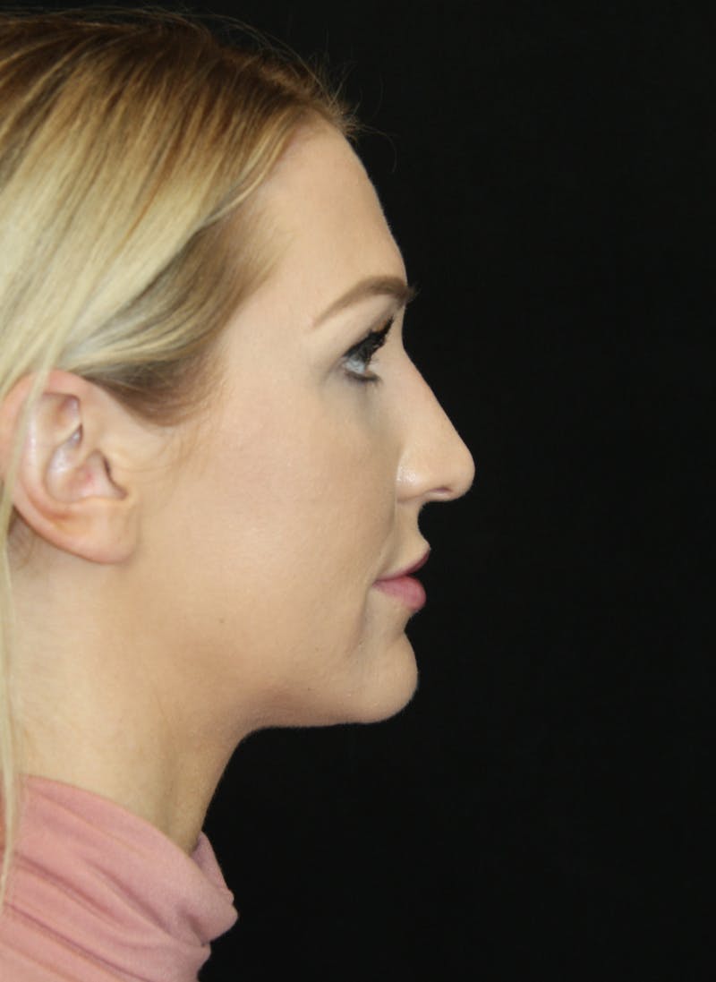 Rhinoplasty Before & After Gallery - Patient 181883655 - Image 5