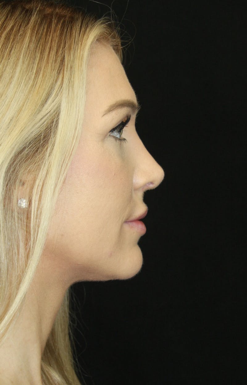 Rhinoplasty Before & After Gallery - Patient 181883655 - Image 6
