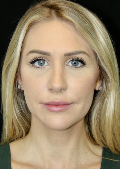 Rhinoplasty Before & After Gallery - Patient 181883655 - Image 2
