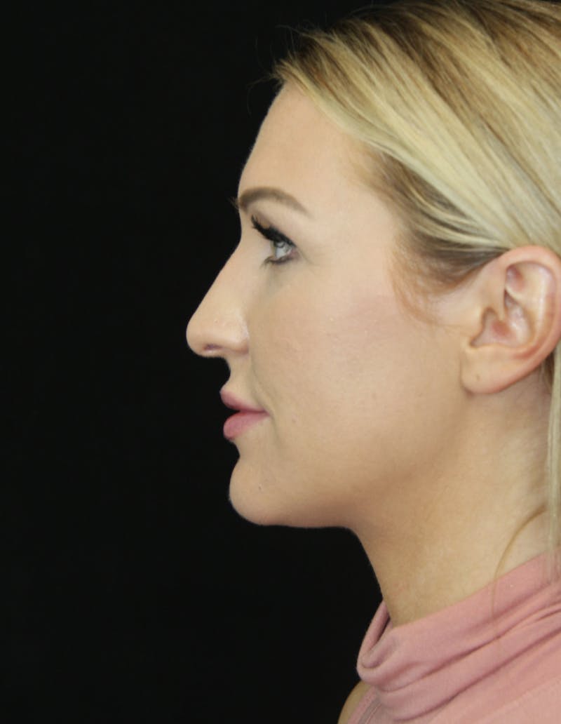 Rhinoplasty Before & After Gallery - Patient 181883655 - Image 9