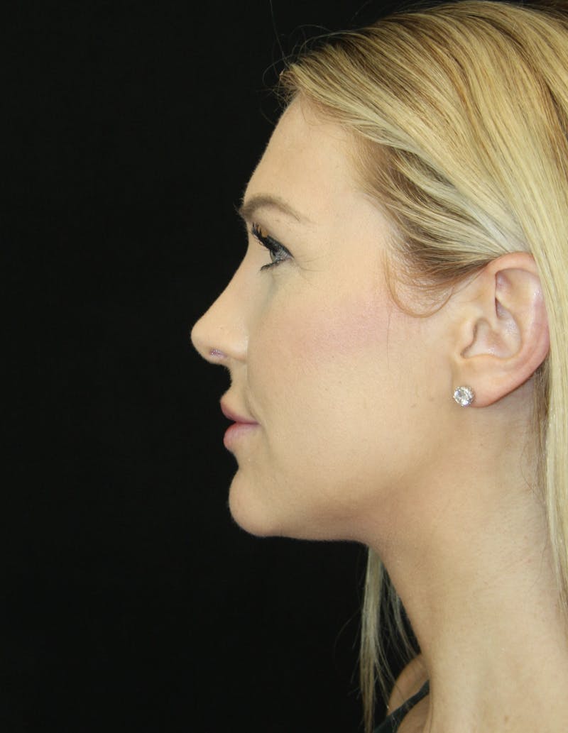 Rhinoplasty Before & After Gallery - Patient 181883655 - Image 10