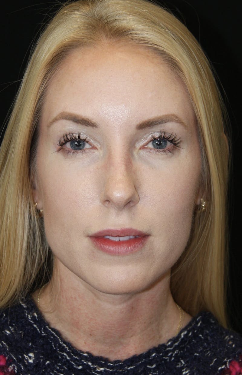 Rhinoplasty Before & After Gallery - Patient 182104574 - Image 1
