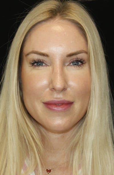 Rhinoplasty Before & After Gallery - Patient 182104574 - Image 2