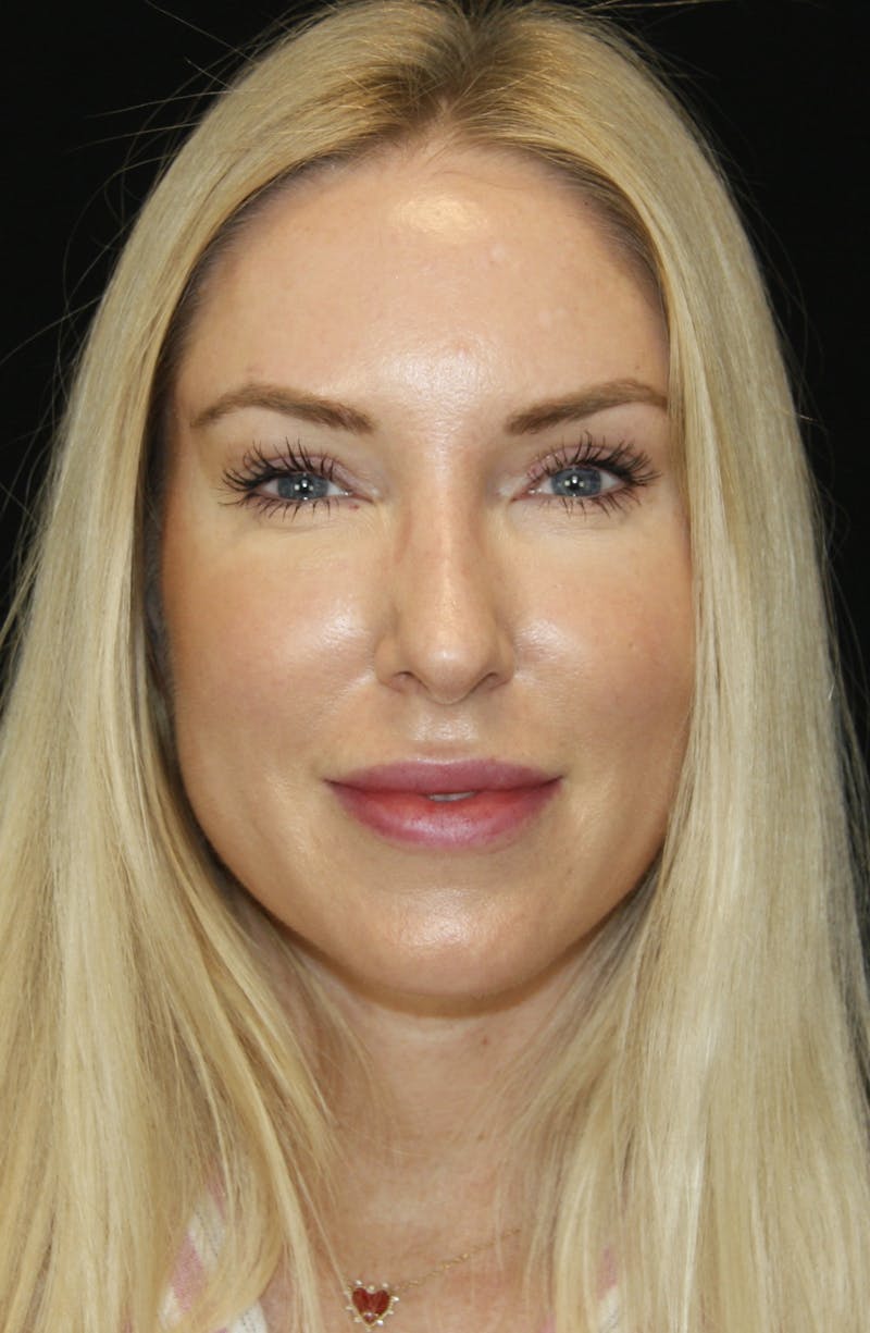 Rhinoplasty Before & After Gallery - Patient 182104574 - Image 2