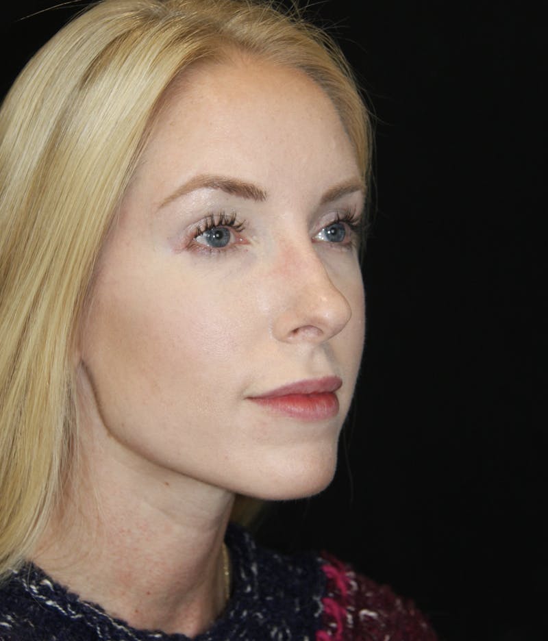Rhinoplasty Before & After Gallery - Patient 182104574 - Image 3