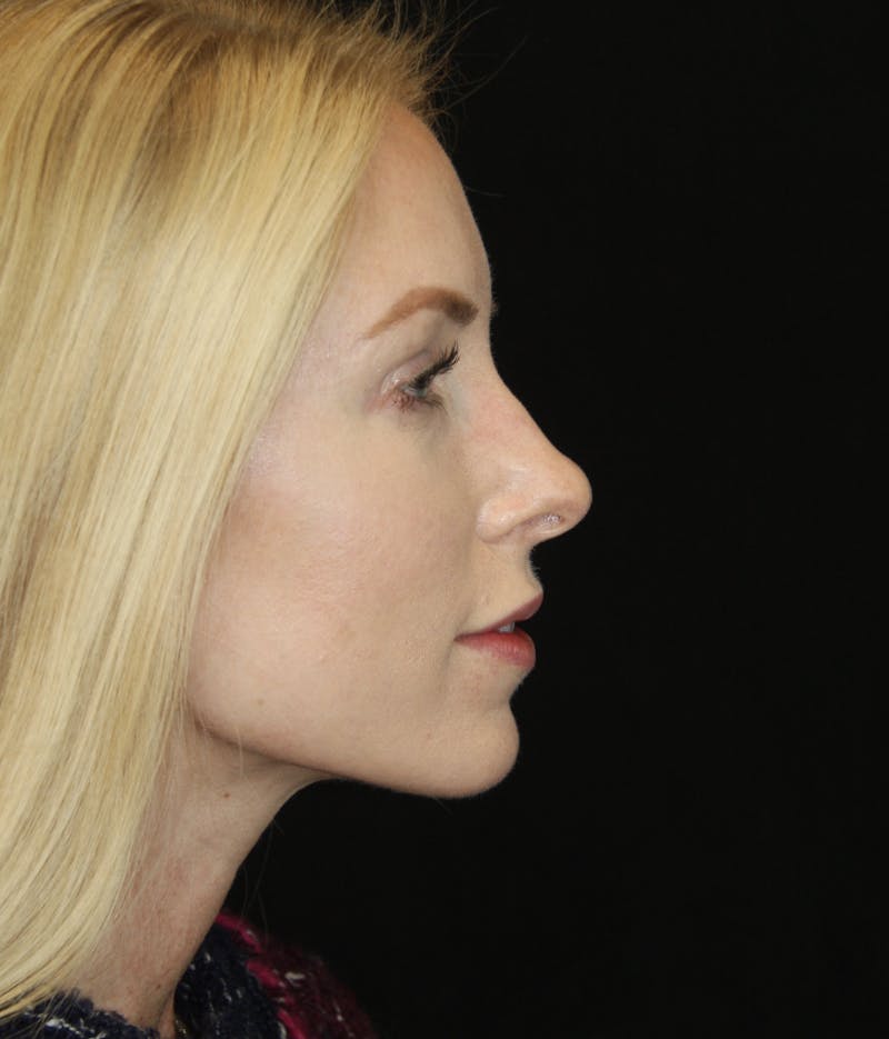 Rhinoplasty Before & After Gallery - Patient 182104574 - Image 5