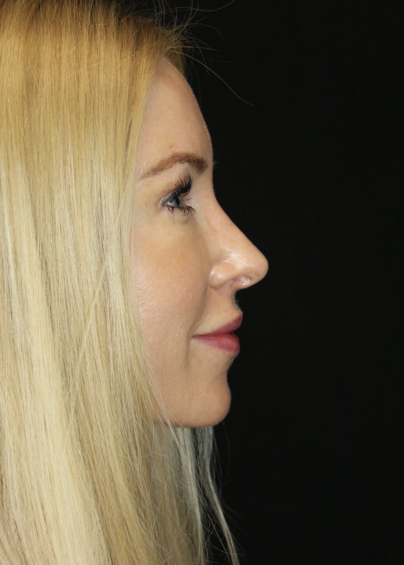 Rhinoplasty Before & After Gallery - Patient 182104574 - Image 6